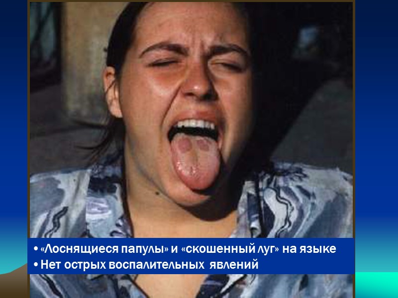 «Лоснящиеся папулы» и «скошенный луг» на языке Нет острых воспалительных  явлений